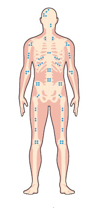 Causes de myélome multiple